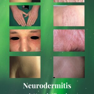 Neurodermitis: Mit Naturheilkunde nachhaltig therapieren (E-Book)