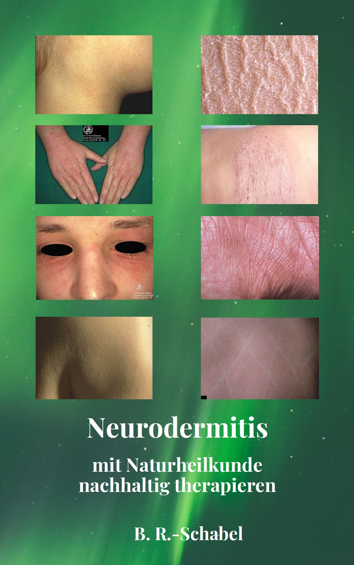 Neurodermitis: Mit Naturheilkunde nachhaltig therapieren (E-Book)